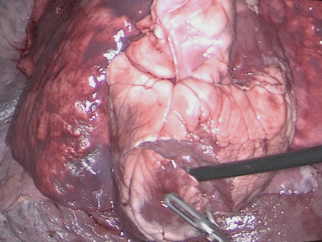 Incision